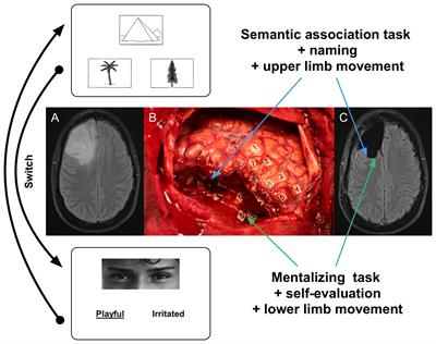 Constant Multi-Tasking With Time Constraint to Preserve Across-Network Dynamics Throughout Awake Surgery for Low-Grade Glioma: A Necessary Step to Enable Patients Resuming an Active Life